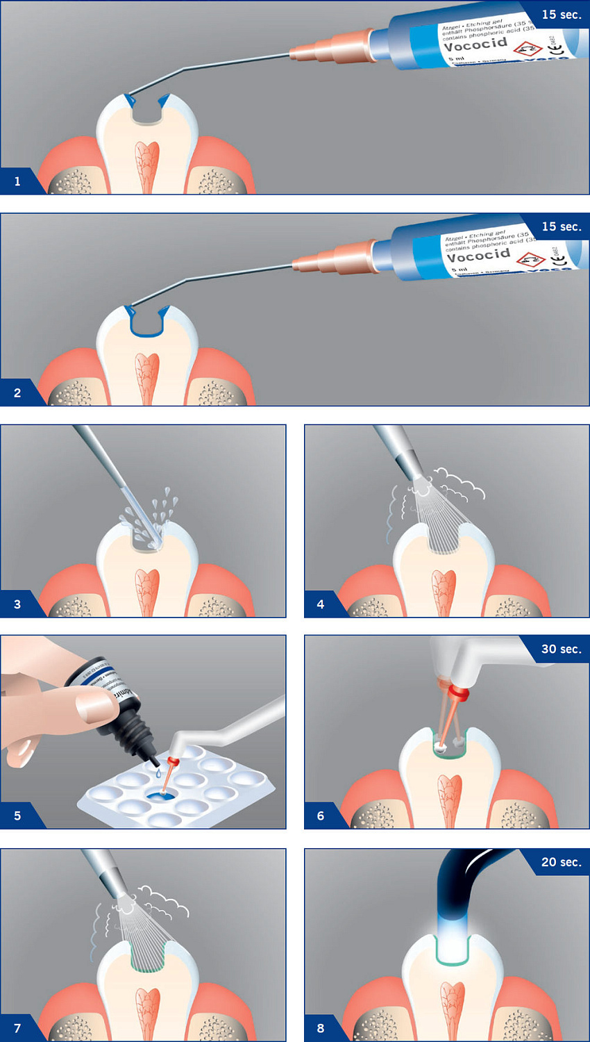 Адмира Бонд (Admira Bond) адгезив 4мл VOCO