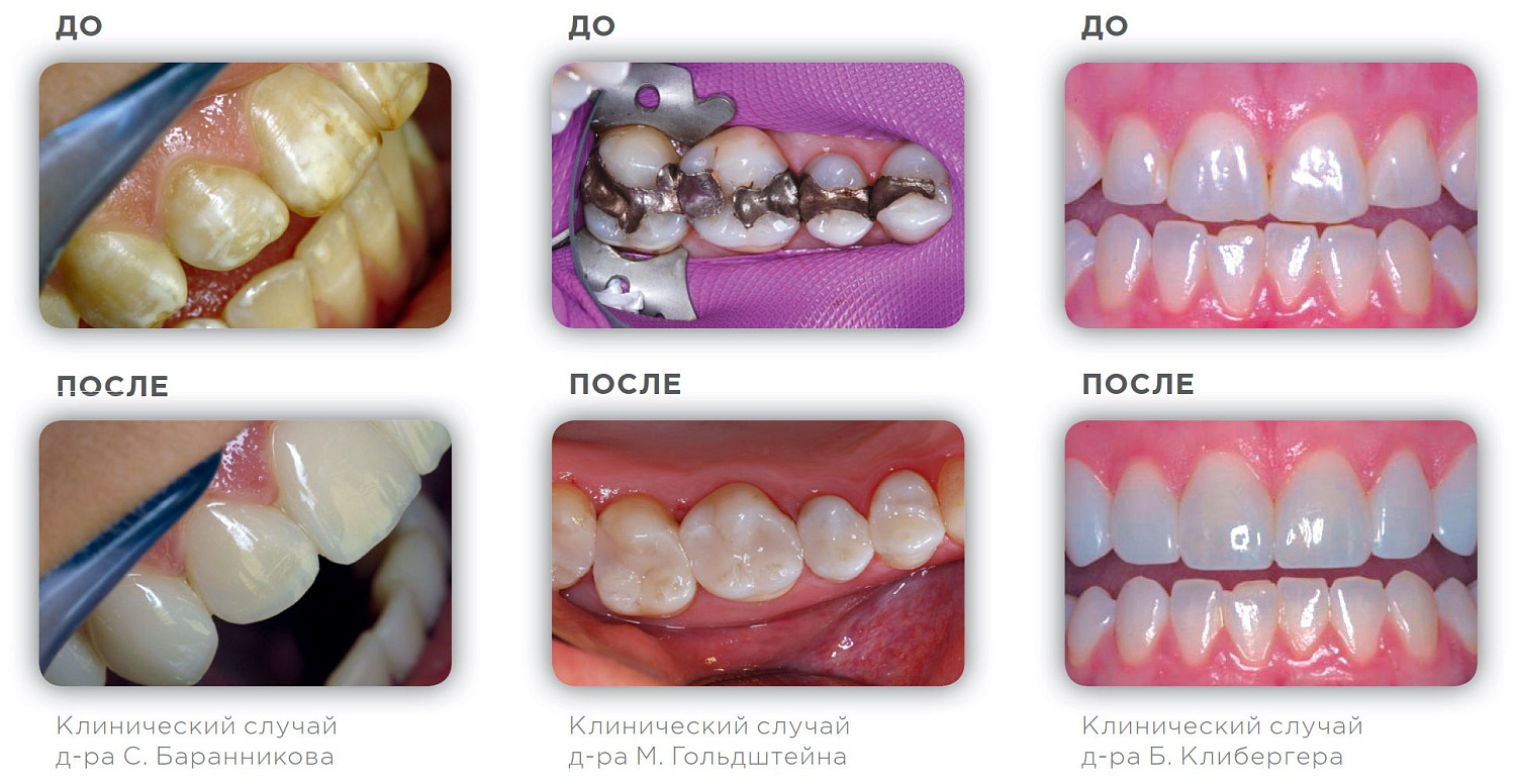 Эстет Икс (Esthet X HD) композит световой Dentsply