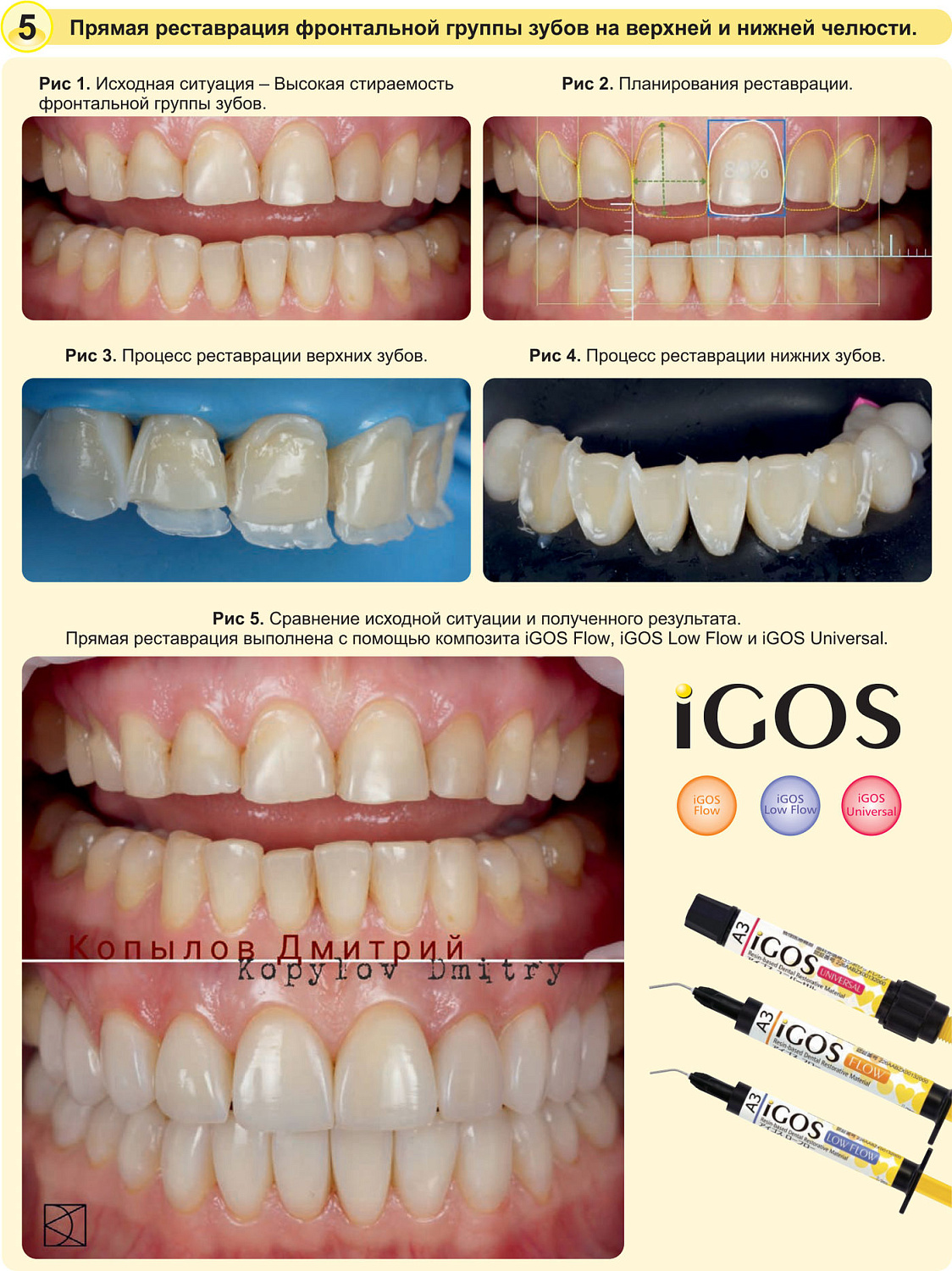 Айгос Юниверсал (iGOS Universal) композит световой Yamakin Айгос Юниверсал (iGOS Universal) композит световой Yamakin