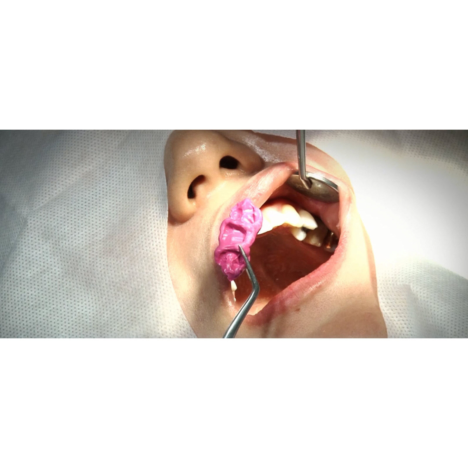 Пикосил (PEAKOSIL Bite Regular Set) А-силикон для регистрации прикуса 50мл Neosil NS011C